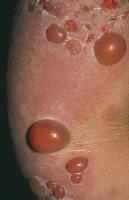 Булёзное поражение кожи на локтевом суставе. Источник: http://www.emedicine.com/