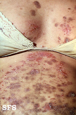 Источник: Дерматологический атлас: http://www.atlasdermatologico.com.br/