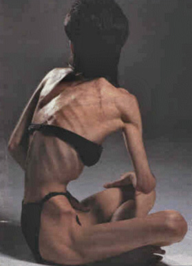 Источник изображения: http://forever.freeshell.org/health/anorexia1.htm